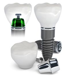 Dental Implants Bellevue, WA - Spektor Dental - Dentist Bellevue